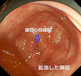 痙攣性便秘や便秘型IBSの一部で観察される拡張した腸管と収縮輪