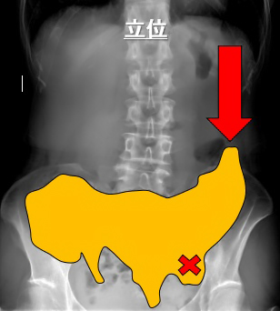 腸管形態異常便秘 X線画像