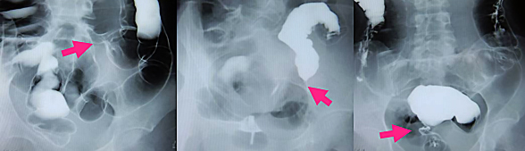 腸管形態異常 X線画像