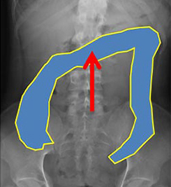 落下腸の方:大腸が正常部位に戻る